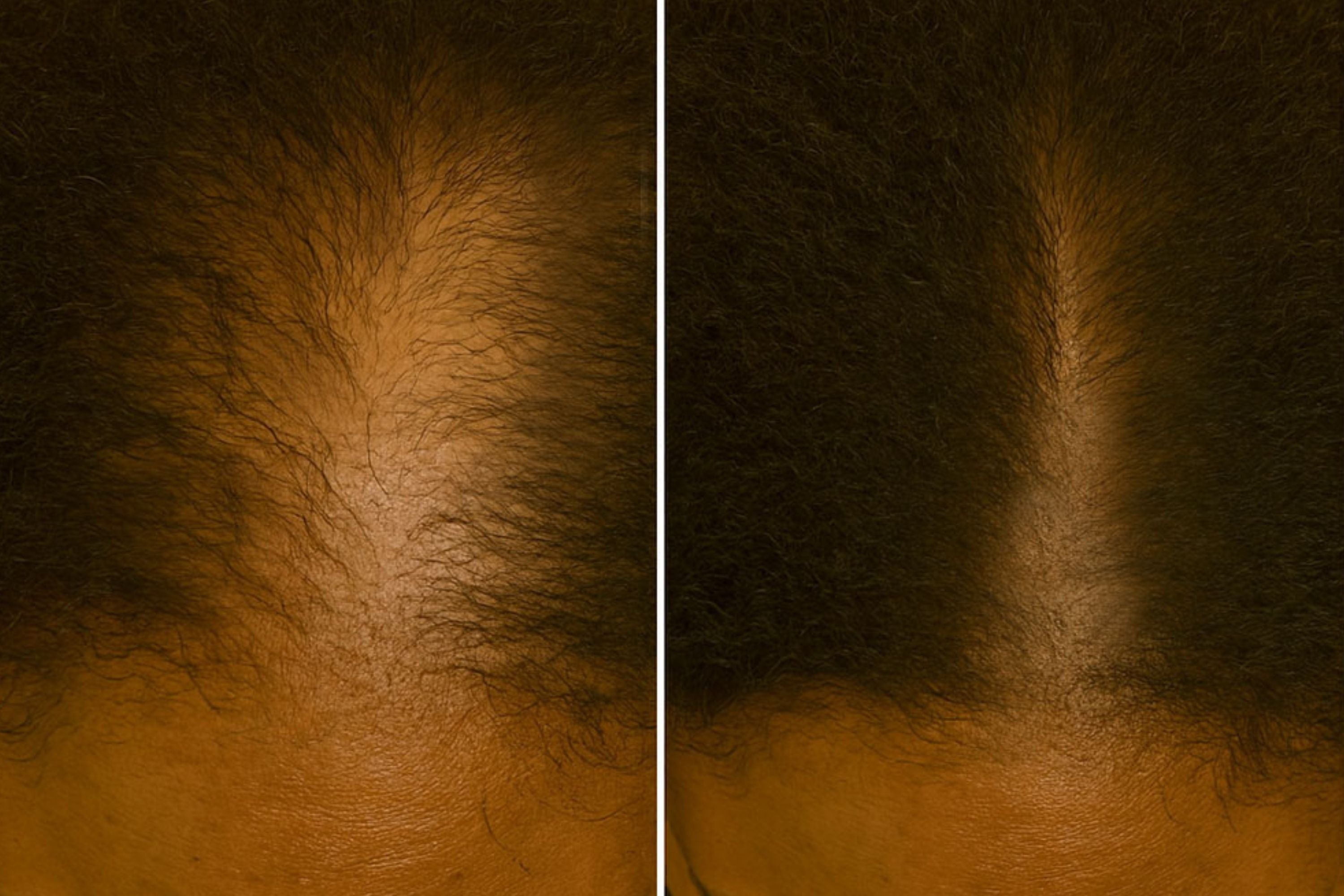 Why Am I Shedding So Much Hair? The Scalp Breakdown No One Talks About