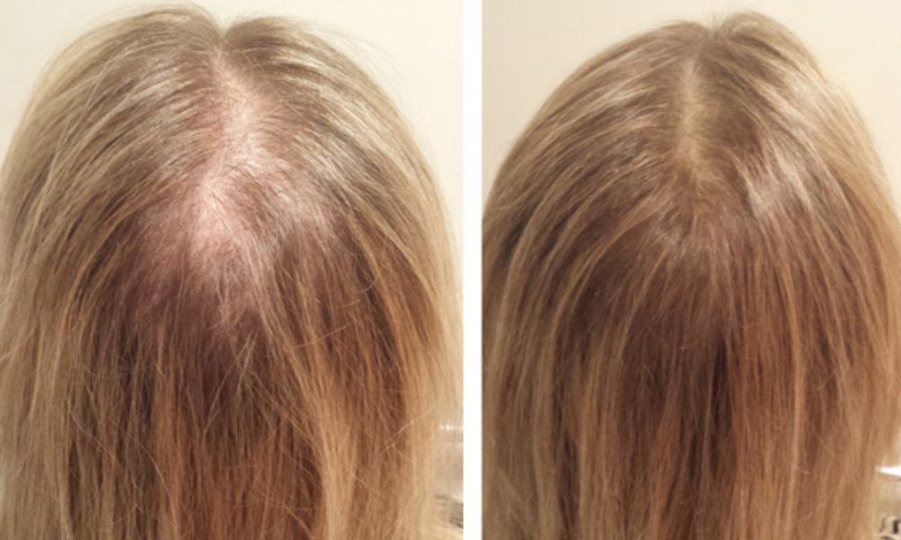 Your Simplified Guide to Scalp Massage and Red Light Therapy for Hair Growth