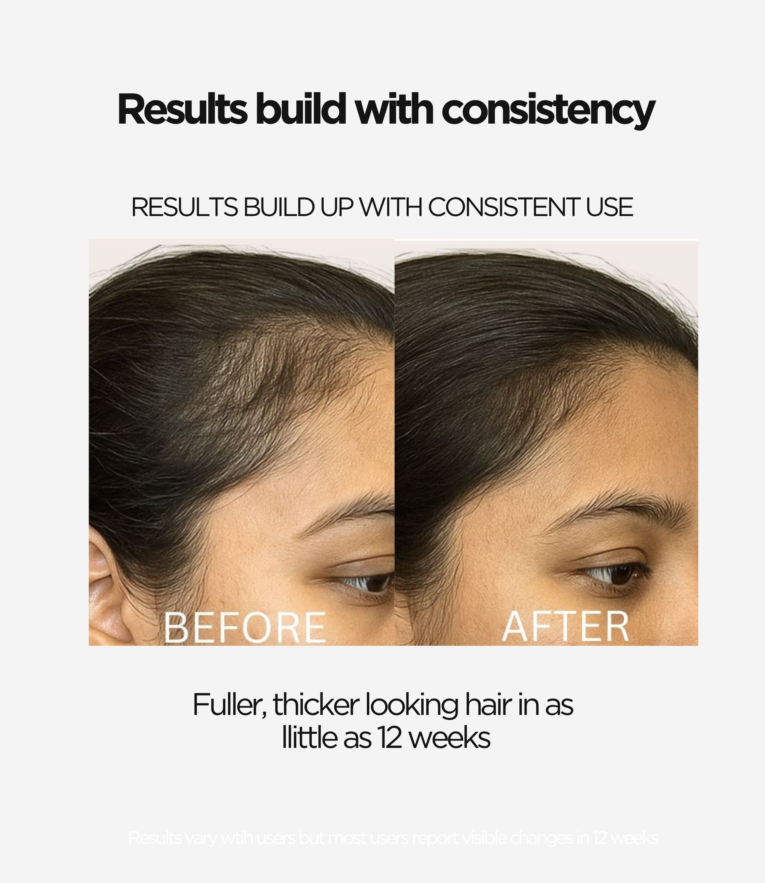 Intensive LED Hair Growth Stimulating Brush: Reduce Shedding
